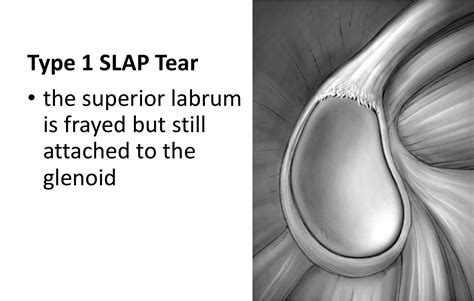 test for slap tear|grades of slap tear.